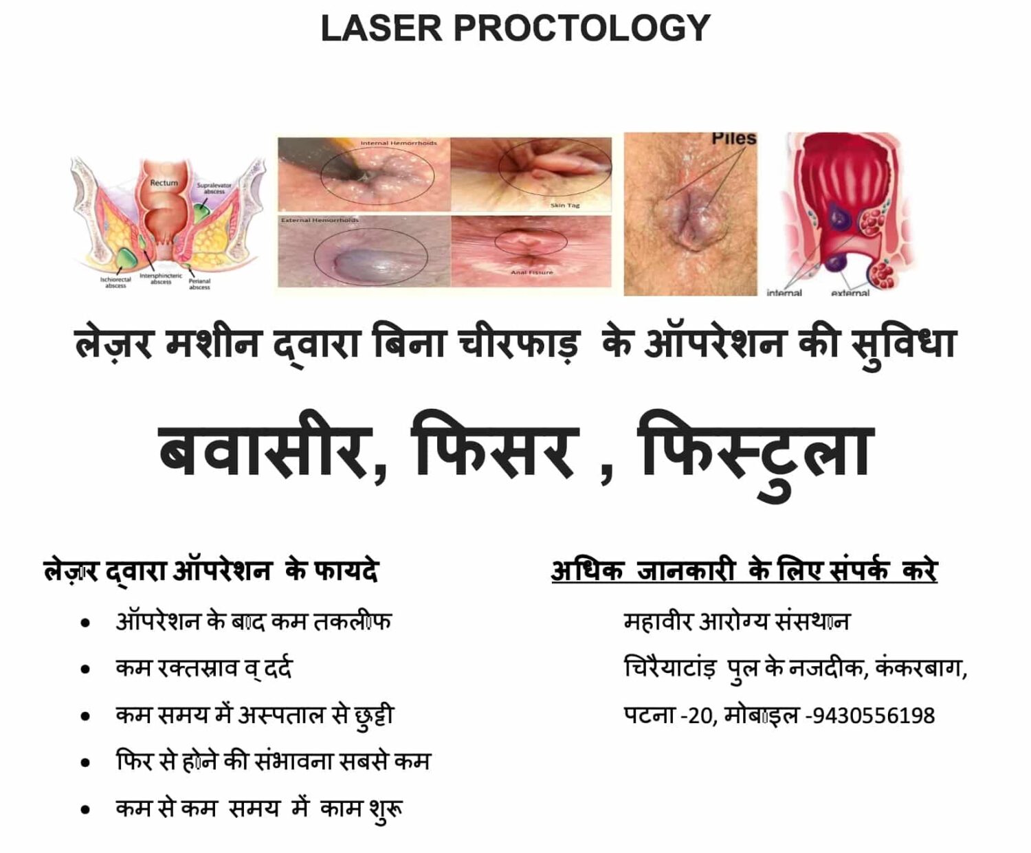 Laser proctology