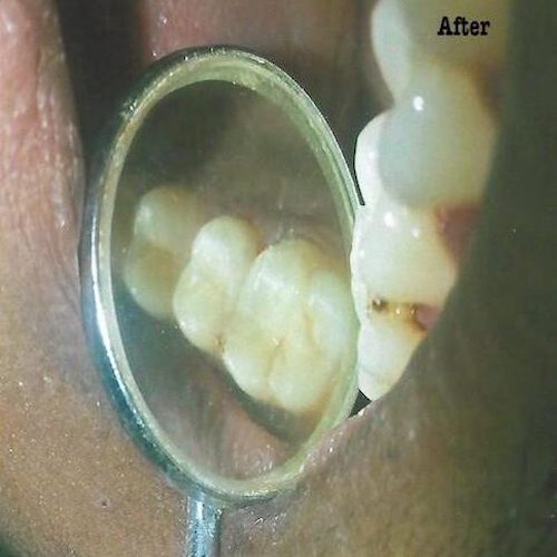 dental-3_after-e1593779400253