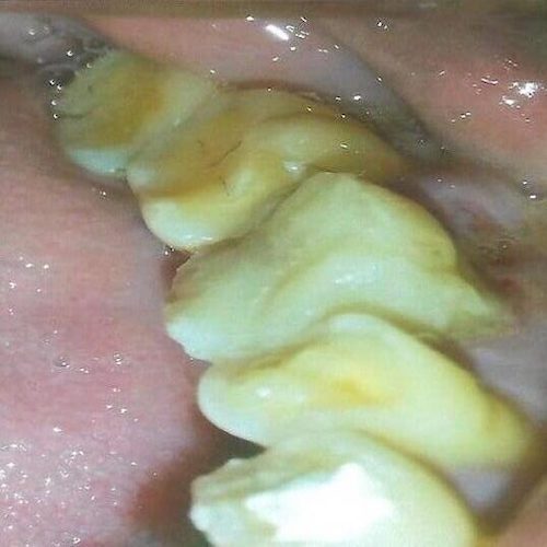 dental-4_after-e1593779518996