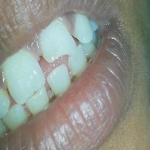 dental-5_before-e1593779576705